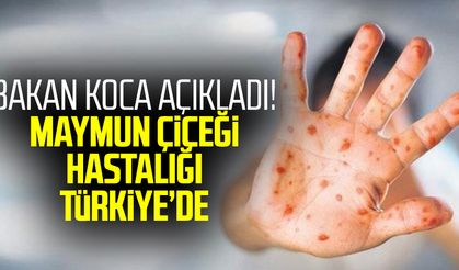 Bakan Koca açıkladı! Maymun çiçeği hastalığı Türkiye'de