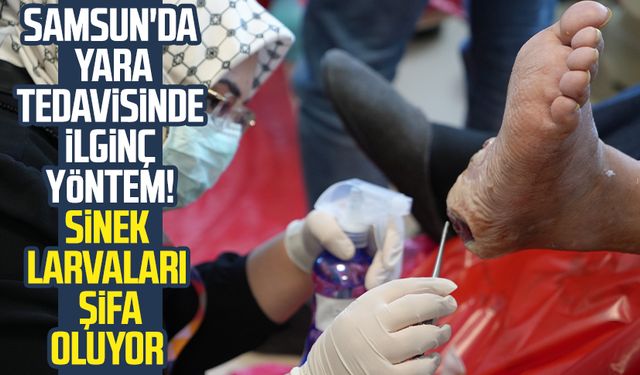 Samsun'da yara tedavisinde ilginç yöntem! Sinek larvaları şifa oluyor