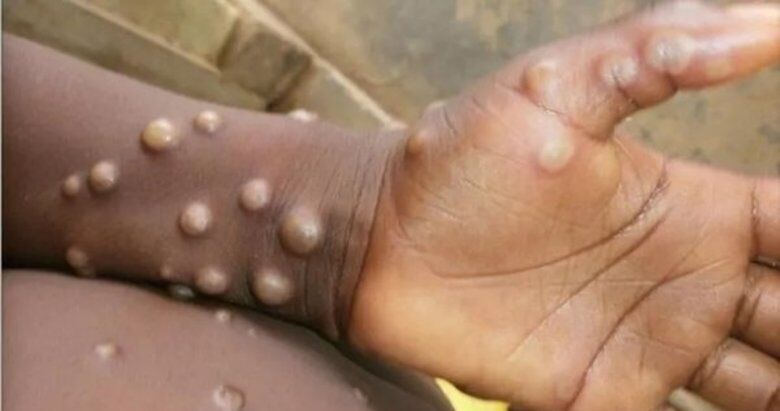 780x411-maymun-cicegi-virusu-nedir-maymun-cicegi-virusu-nasil-bulasir-belirtileri-neler-1653038667534