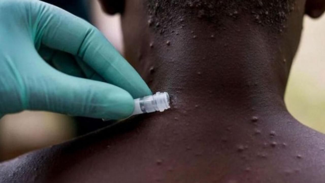 bir-ulkede-daha-maymun-cicegi-virusu-tespit-edildi