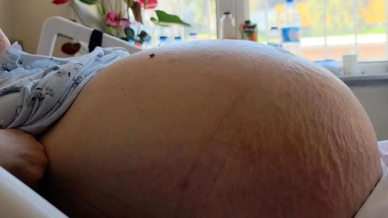 Doktorları bile şaşırtan vaka! Kabızlık sandı ama karnı burnuna geldi